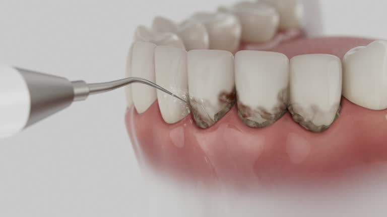 Trusted Wisdom Tooth Removal service in Lemmon, SD - Dentist Open Now
